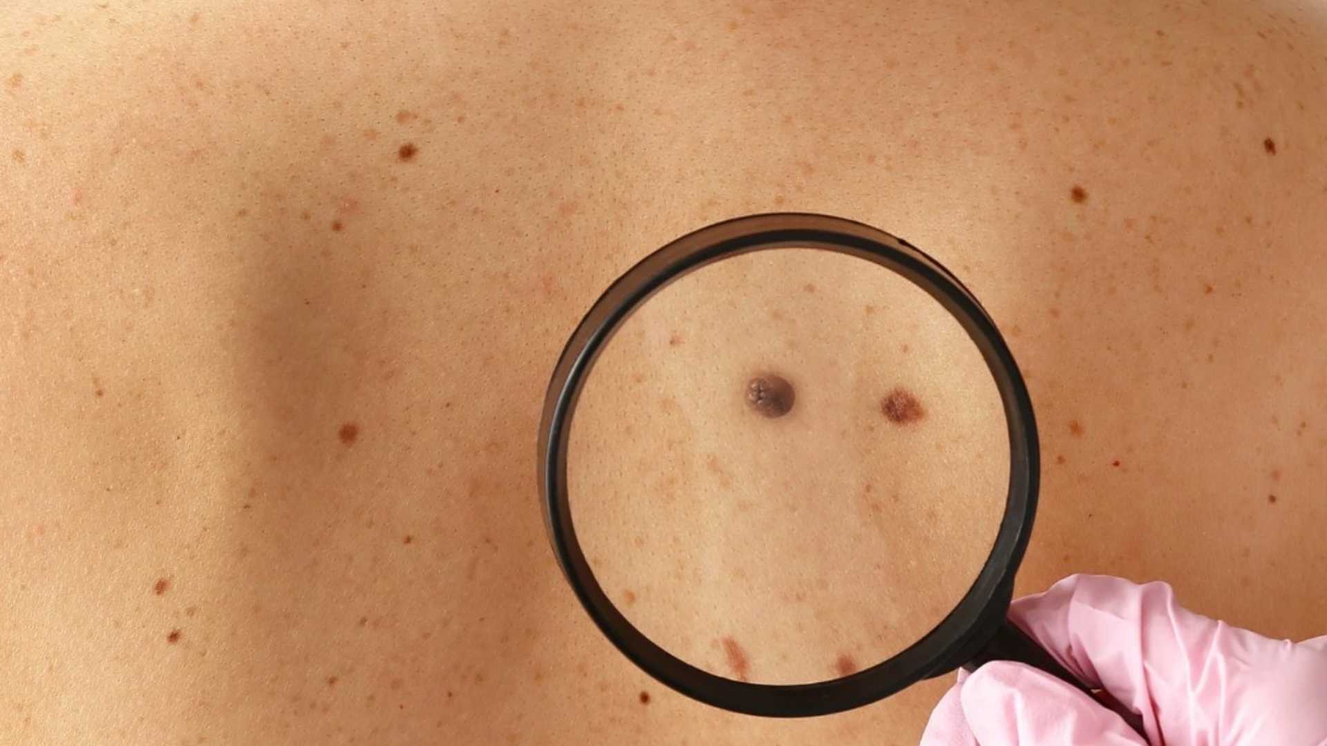 Sole e melanoma, la SIDeMaST contro le fake news