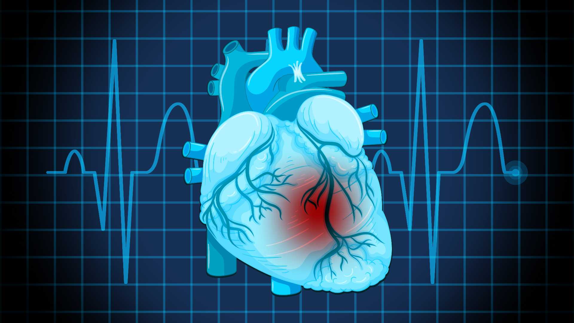Infarto del miocardio, cambia la definizione: non basta la troponina, conta la causa