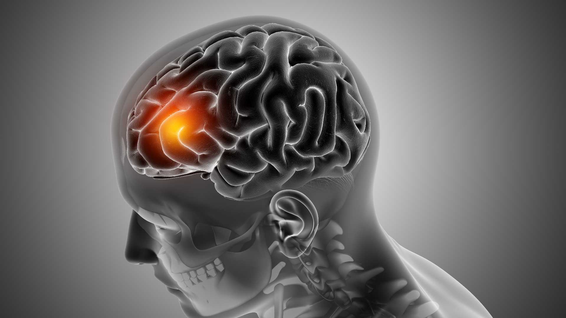 Glioblastoma, il tumore cerebrale più aggressivo